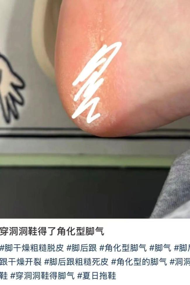 广东人爱穿洞洞鞋小心脚气 潮湿环境增风险
