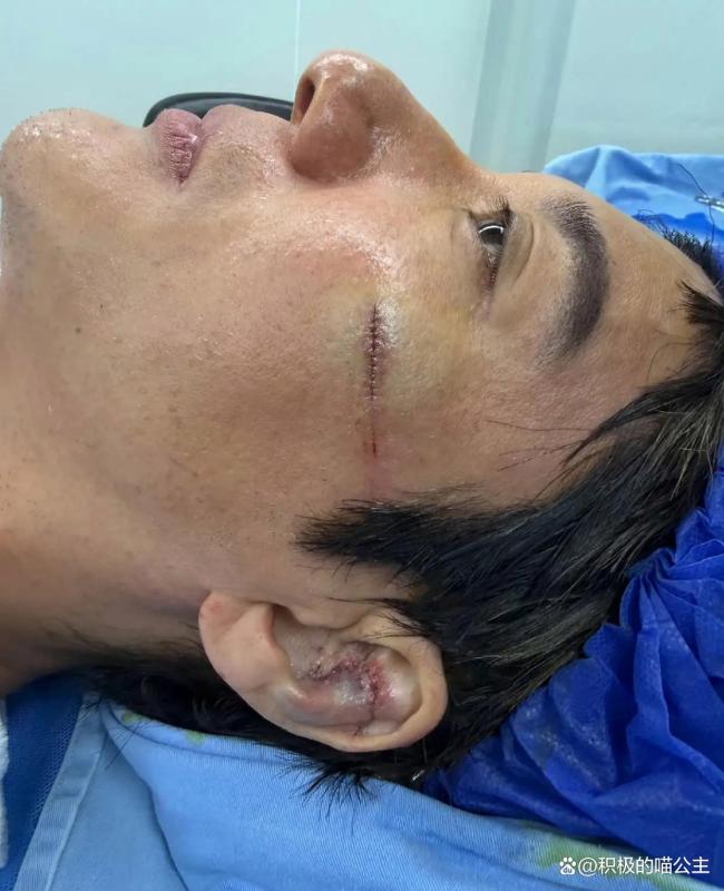 王力宏缝了39针