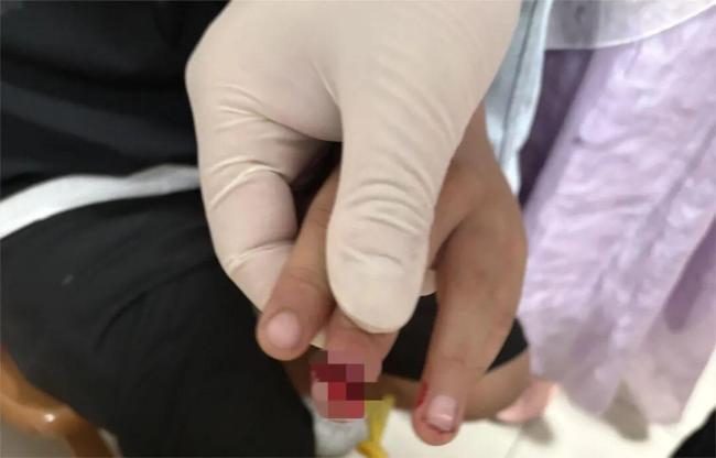女孩玩捉迷藏一头撞上玻璃门 暑期儿童外伤频发引关注
