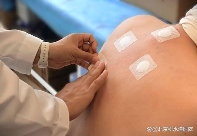 积水潭医院三伏贴开始预约 三个院区均可预约就诊