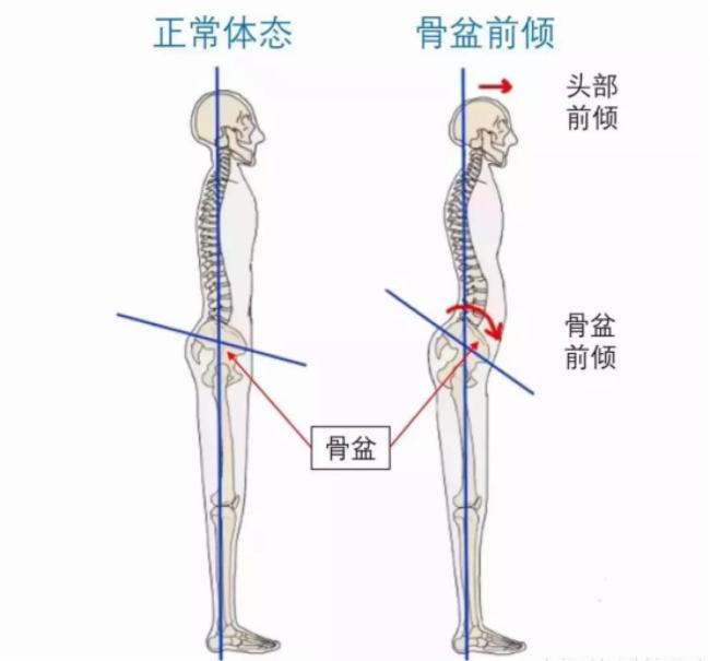 医生提醒长期模仿哈兰德有颈椎风险 职业专属技巧勿盲目跟风