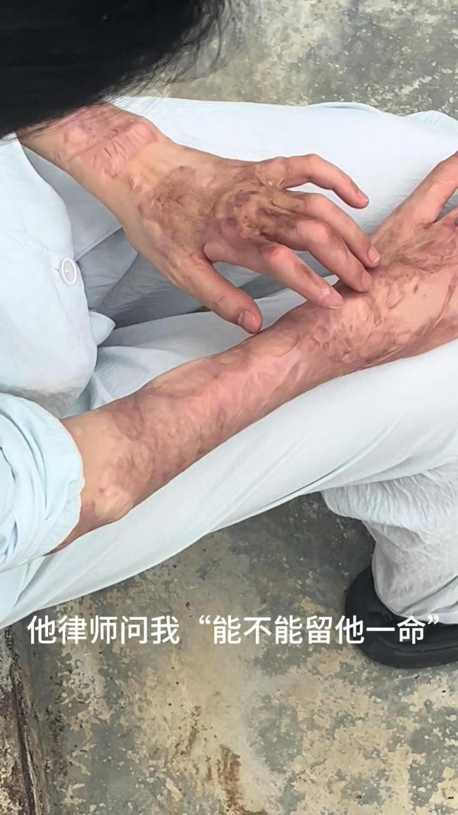 泼硫酸男子被执行死刑 受害人发声 正义虽至生活难续
