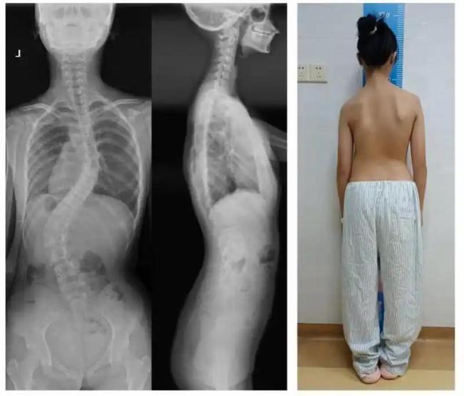 12岁女孩确诊重度脊柱侧弯 医生发声