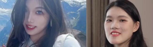 女孩正颌后成“鞋拔子脸” 医生停诊 手术引发争议