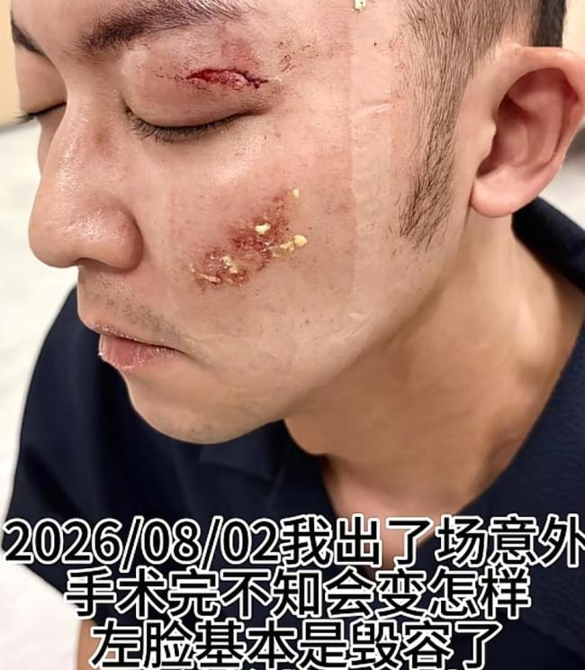 演员陈威翰遇到严重车祸左脸受伤 左眼失明风险引担忧
