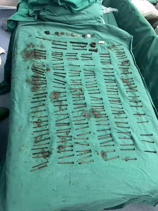 云南男子胃中取出180颗铁钉 罕见病例引关注