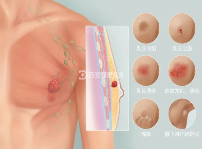 61岁大爷胸前长痘确诊乳腺癌 男性也需警惕
