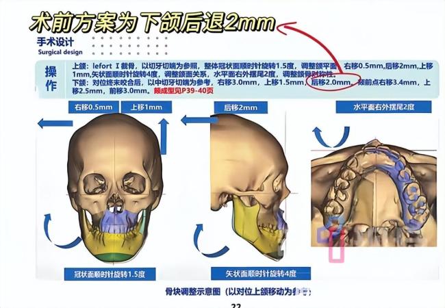 正颌手术被做反女孩:已达成和解,希望回归正常生活