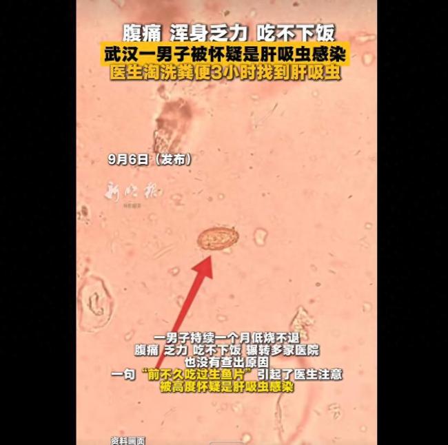医生淘洗粪便3小时找到肝吸虫