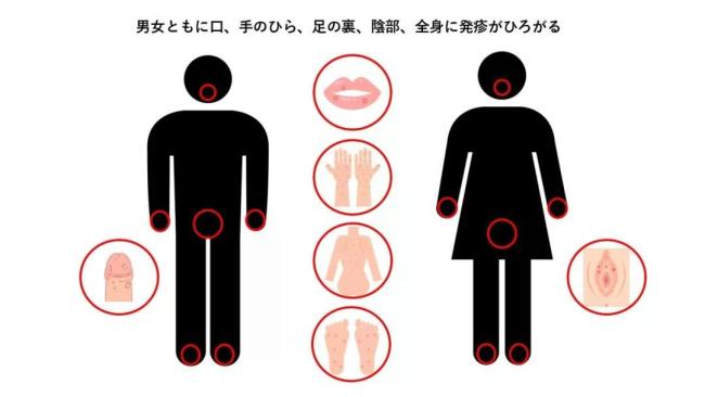 日本为何会出现梅毒疫情 药物短缺与社会因素交织