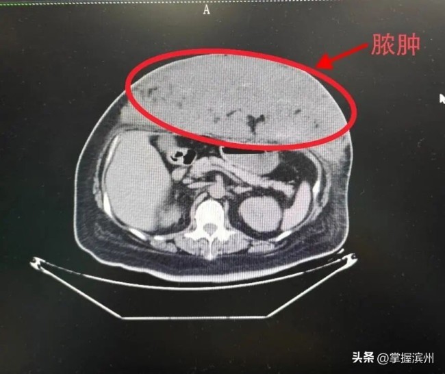 40岁女子被蚊虫叮咬腹部长出小脓包 医生:隐匿糖尿病是“推手”