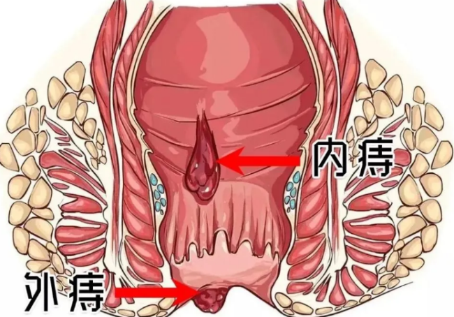 痔疮肉球 症状图片