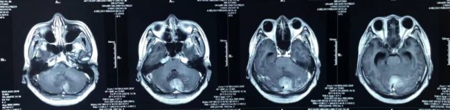银丰（济南）医院神经肿瘤科团队大胆尝试新药，助力恶性程度4级并已转移扩散的髓母细胞瘤患者重燃希望