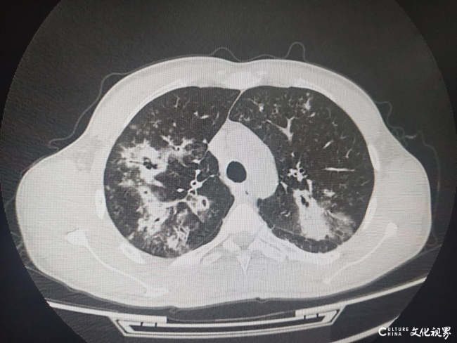 泰安市中心医院急诊内科成功开展纤维支气管镜下肺泡灌洗术，实现急性感染救治新突破