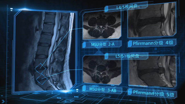 昨天手术 今天出院——山大齐鲁二院GPTSP赋能为腰椎“老病号”找到微创最优解