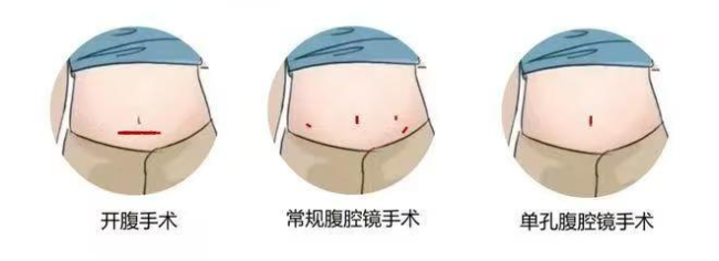 微创无痕解病痛！泰安市中心医院单孔腹腔镜技术，守护女性健康与体面