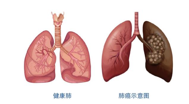 肺癌是怎么得来的？