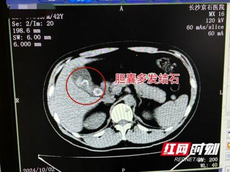 男子腹部疼痛多年误以为是胃痛所致 胆囊结石作祟