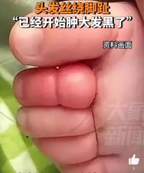 女婴脚趾被头发缠绕发现时已肿大 家长细心排查解危