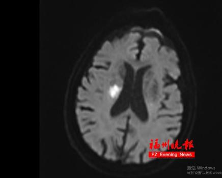 感冒后想“扛一扛” 男子突發(fā)腦梗死 小病不可輕視