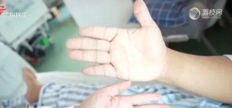 男子突然變丑 下唇比上唇厚一倍 竟是垂體瘤作祟
