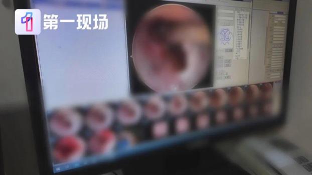 小伙脖子腫痛開(kāi)刀取出7顆瓜子 罕見(jiàn)病梨狀窩瘺作祟