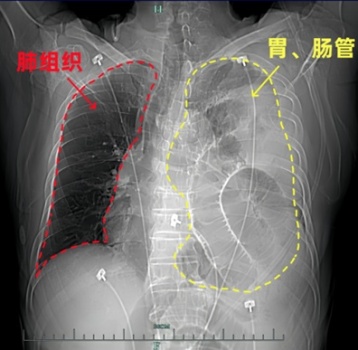 男子体检发现左肺“消失” 40岁惊觉身体异样