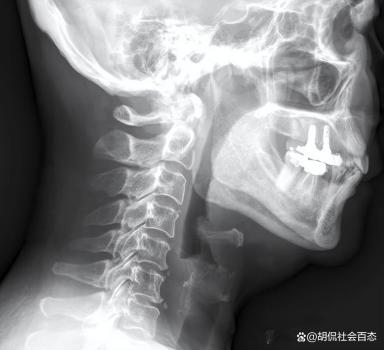 男子中午吃一条鱼 下午上班死亡 小鱼刺引发大悲剧