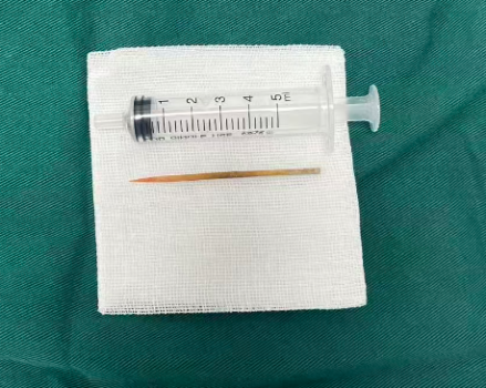 男子喝水误吞牙签致肠穿孔 小牙签险酿大祸