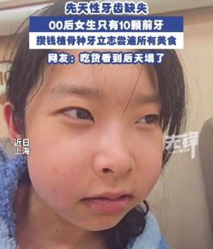先天性牙齿缺失 00后女子天生只有10颗牙