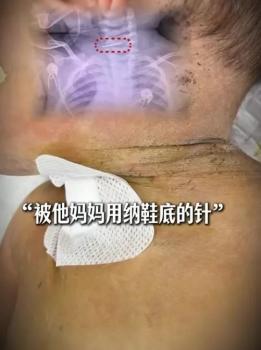 10月龄男婴被母亲扎数百针 官方回应 多方介入调查