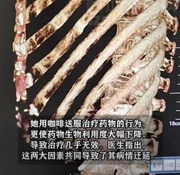 女子吃药用咖啡送服直呼治了个寂寞 药物禁忌需谨记