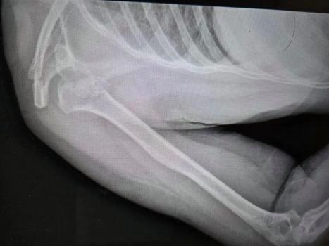 女子在睡梦中粉碎性骨折 癫痫发作所致