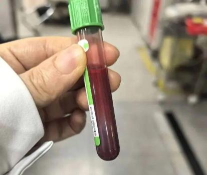 28岁孕妈一周胖10斤后被送ICU 美食狂欢引发危急状况