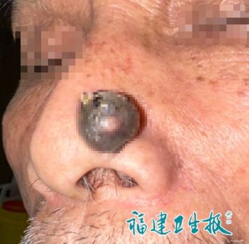 大爺鼻子上長(zhǎng)了小疙瘩竟確診是癌 不疼不癢卻暗藏危機(jī)
