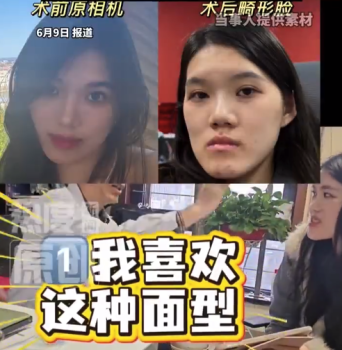 主刀醫(yī)生回應(yīng)女孩正頜變鞋拔子臉：我喜歡這種面型，現(xiàn)在的面型比之前更洋氣