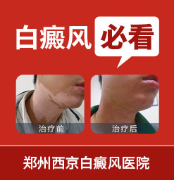 郑州治疗白癜风的比较好医院在哪 郑州白癜风医院怎么治疗手上白癜风
