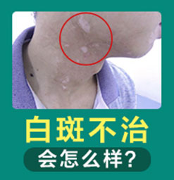 郑州看白斑去哪家医院好 郑州西京医院专业吗