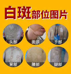 郑州治疗白癜风好的医院有哪些 郑州西京医院怎么样