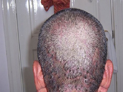 头部皮癣治疗方法   头皮癣要怎么治疗