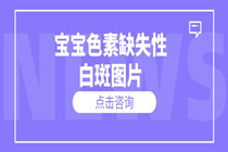 东莞白癜风医院哪个好 宝宝色素缺失性白斑图片