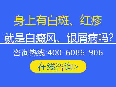 长春银屑病手术医院-长春银屑病医院