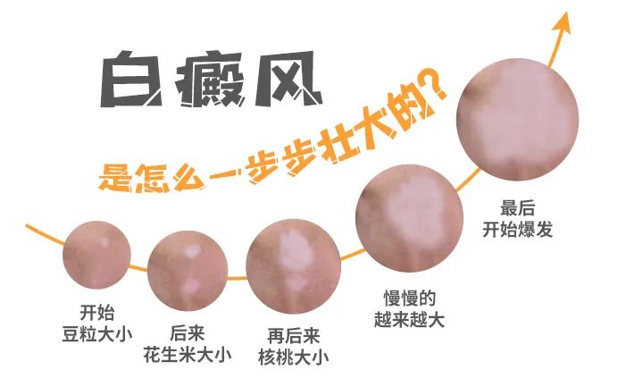 烟台去哪里治疗白癜风好 山东烟台白癜风医院