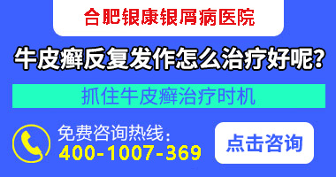 点滴银屑病和点滴副银屑病区别_点滴型银屑病与副银屑病区别