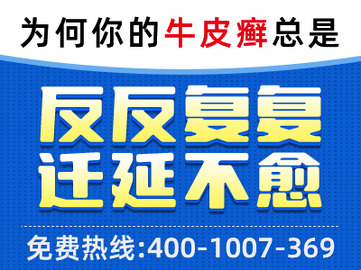 夏天日光浴对银屑病有用吗_冷水浴能改善银屑病吗