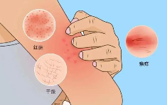 上海的皮肤病医院排名-皮肤瘙痒警惕9种疾病