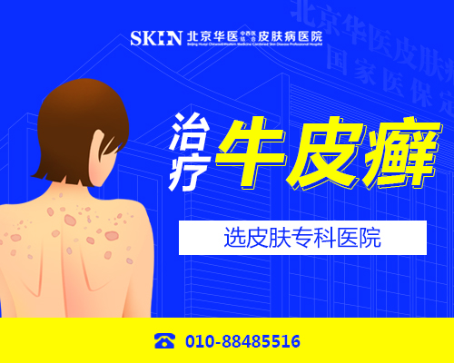 北京中西医结合医院看牛皮癣-牛皮癣患者皮肤瘙痒怎么缓解护理