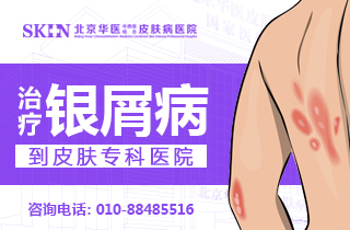 北京看银屑病哪个医院治疗好-女士银屑病影响生育吗