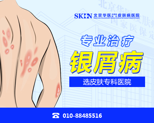 北京银屑病关节炎哪个医院治疗好-银屑病关节炎可以运动吗
